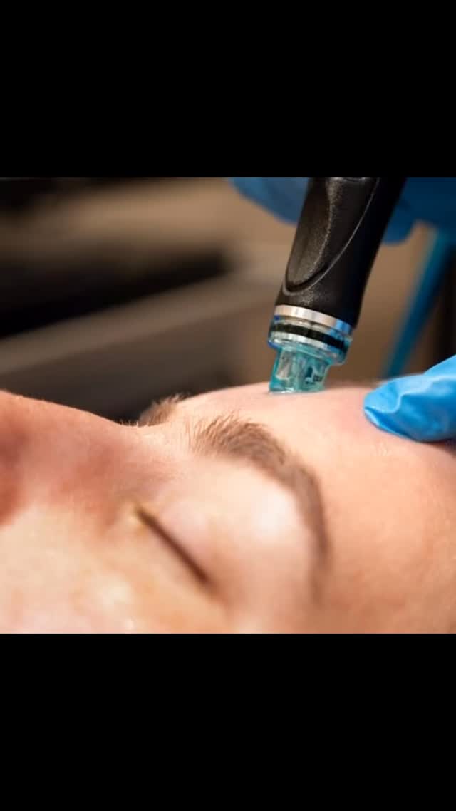 HydraFacial treatment wand on a client's face at Beyond Skin & Body Care