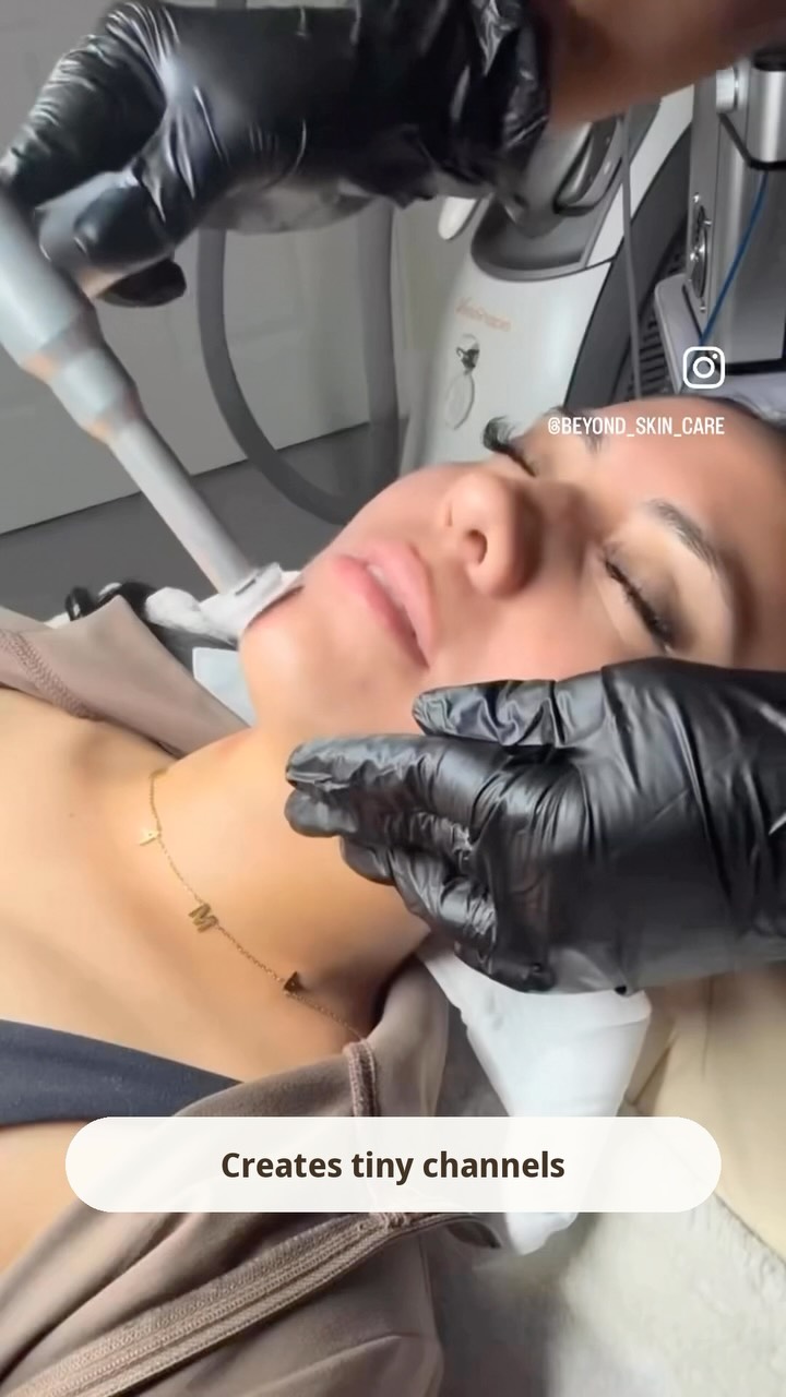 Procell microchanneling treatment on a client at Beyond Skin & Body Care in Henderson
