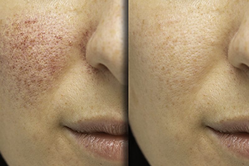Close-up of facial skin texture, side by side.